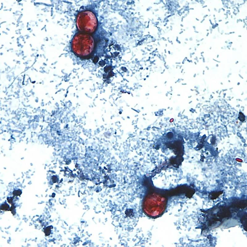 旅美注意！全美31州现寄生虫感染密西根暴增逾2600例 配图