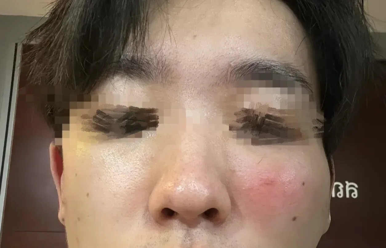 中国游客在泰国自称两度遭外籍男子袭击，右眼一度失去感光近20分钟 ... — 正文配图
